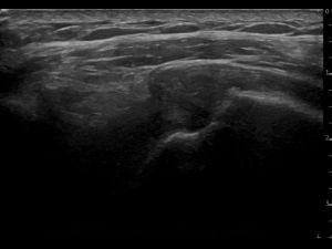 Longitudinal: ultrasound guided active abduction supraspinatus tendon, SASD bursa and coracoacromial ligament