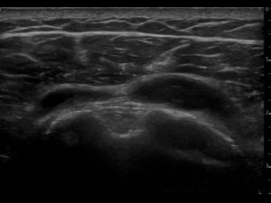 Transverse: long head of the biceps tendon and SASD bursa