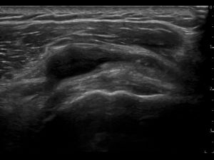 Longitudinal: subscapularis tendon and SASD bursa