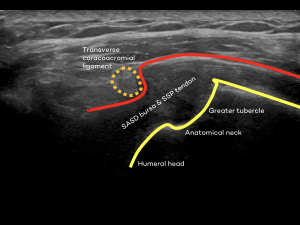 Longitudinal: ultrasound guided active abduction supraspinatus tendon, SASD bursa and coracoacromial ligament