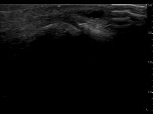 Longitudinal: ultrasound guided functional flexion DIP 3 joint (18Mhz hockeystick transducer)
