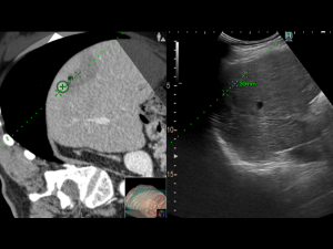 A small recurrence near previous postablation area previously performed for HCC treatment 