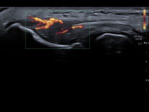 Case: Partial tear common extensor tendon 