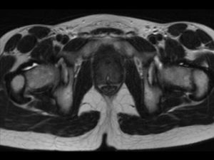 Axial T2 image through the prostate from 2015 demonstrates a significantly enlarged prostate returning homogeneous low T2 signal, a catheter in the urethra and a small midline prostatic cyst. The zonal anatomy is not well delineated.