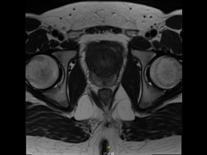 Axial T2 image through the prostate from 2021 demonstrates further interval enlargement of the prostate demonstrating the typical high T2 signal peripheral zone and the bland low T2 signal transitional zone encroaching on the bladder neck.