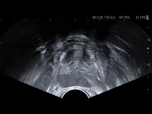 Axial view of the prostate gland at midline with no needle inserted. Note surrounding perimeter of fibromuscular tissue (prostate capsule) and urethra location.