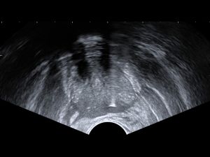 Transrectal ultrasound image in axial view of the prostate gland demonstrating biopsy of L posterior sector, peripheral zone