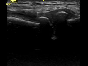 Lateral Knee Compartment