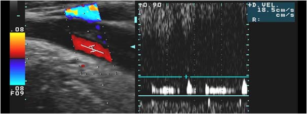 Subtotal occlusion of the common carotid artery