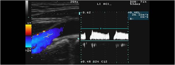 Physiological flow direction but abnormal doppler signal in the internal carotid artery