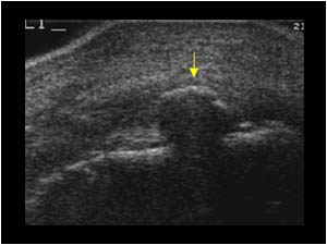 Tendon calcification on the left side