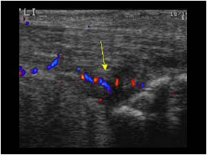 Thickened bursa with synovial thickening and hypervascularity on the left side