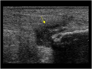 Thickened bursa with synovial thickening on the right side longitudinal