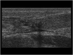 Full thickness achilles tendon rupture
