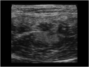 Muscle rupture with fibrosis transverse