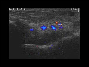 Rheumatoid arthritis of the ankle with synovial thickening
