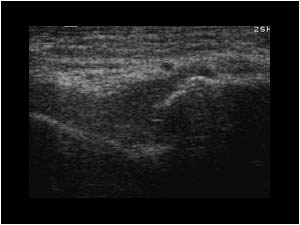 Rheumatoid arthritis of the ankle with synovial thickening
