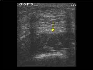 Synovial thickening and effusion in the dorsal right ankle transverse