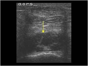Synovial thickening and effusion in the dorsal right ankle transverse