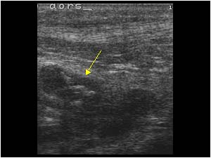 Effusion and loose bodies in the dorsal right ankle longitudinal