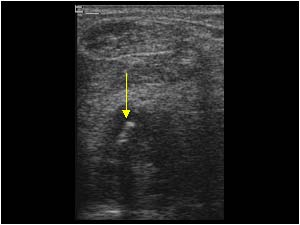 Effusion and loose bodies in the dorsal right ankle longitudinal