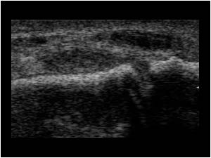 Longitudinal interphalangeal joint synovial thickening
