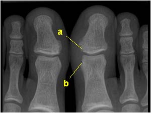Arthritis foot