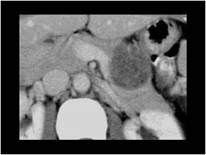 Benign pancreas tumors in corpus and cauda