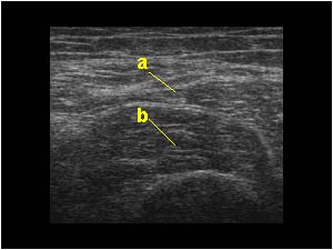 Absent distal muscle transverse