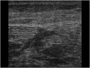 Vastus lateralis muscle rupture longitudinal