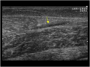 Hematoma gastrocnemius muscle rupture longitudinal