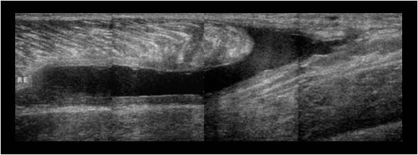Distal gastrocnemius muscle rupture longitudinal