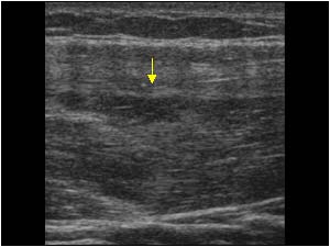 Pectoralis muscle rupture longitudinal