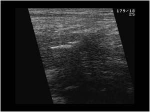 rectus femoris muscle calcification longitudinal