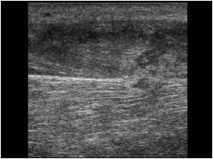 thickened peroneal muscle with loss of fibrillar structure longitudinal
