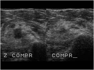 vascular malformation with and without compression transverse