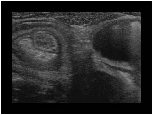 Intussusception and small bowel dilatation