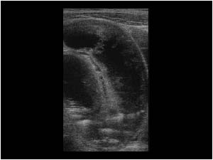 Small bowel dilatation (ileus)