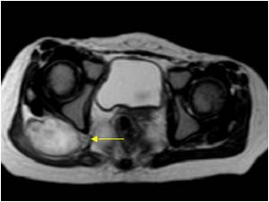 Abdominal and retroperitoneal tumors in infants