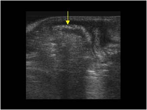 Umbilical hernia with air filled bowel loop
