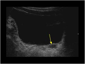 Varying dilatation of the left ureter transverse