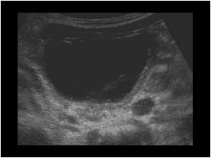 Reflux in the left ureter with slight dilatation transverse