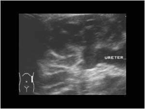 Renal and ureteric dilatation