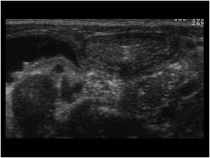 Ureteric dilatation right and empty bladder