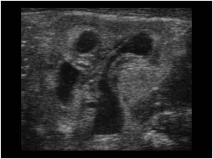 Renal dilatation left with thickening of the calyceal walls transverse