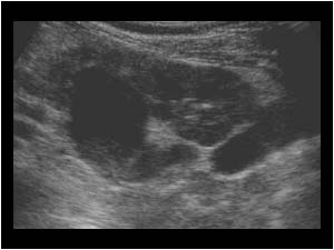 Dilatated upper pole with internal echos in the ureter and renal pelvis