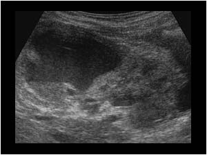 Cystic dysplastic upperpole of the right kidney