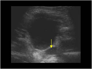 Dilatation of the left ureter transverse