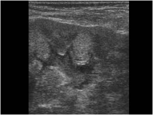 Thickening of the calyceal and pelvic walls and internal echos