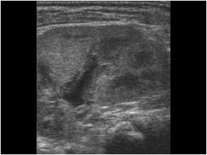 Thickening of the calyceal and pelvic walls